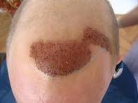 FUE Hairline Clinic image 2